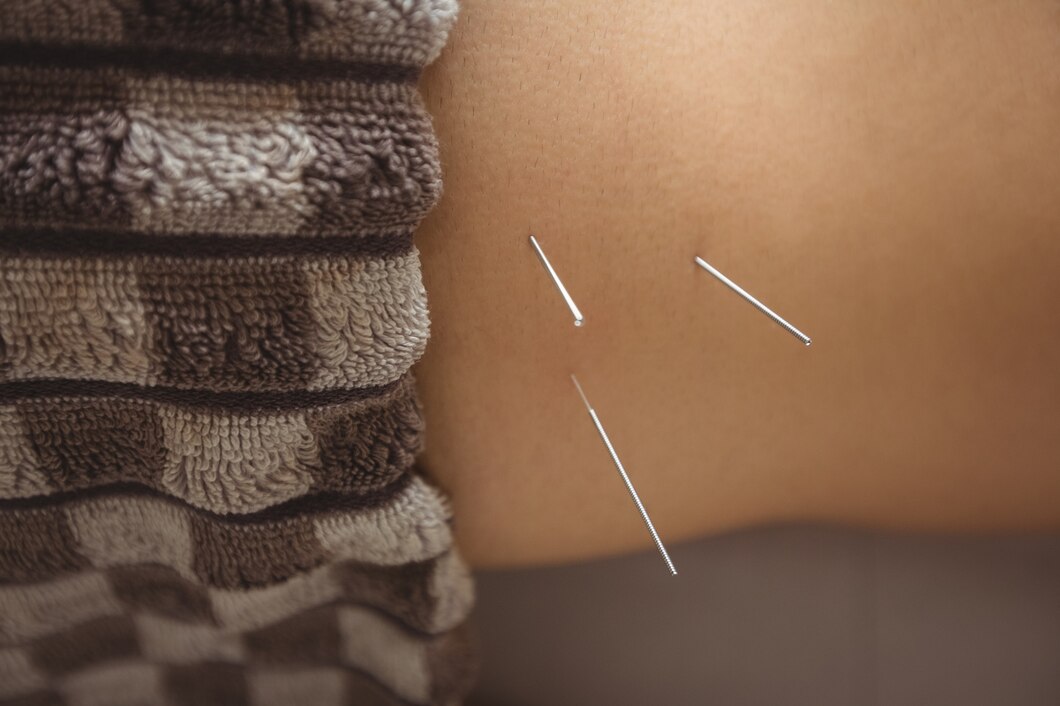Jak akupunktura może pomóc w leczeniu przewlekłego bólu? Poradnik pacjenta